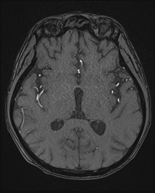 Cerebral embolic infarcts (embolic shower) (Radiopaedia 72391-82921 Axial MRA 92).jpg