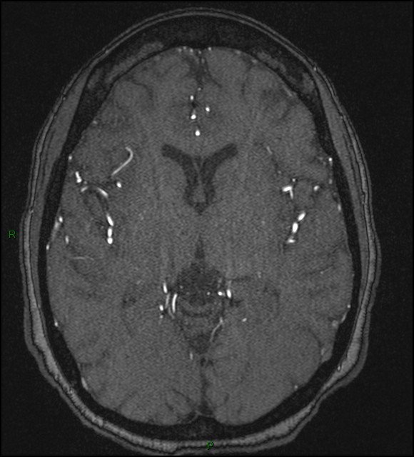 Cerebral fat embolism (Radiopaedia 35022-36525 Axial TOF 103).jpg
