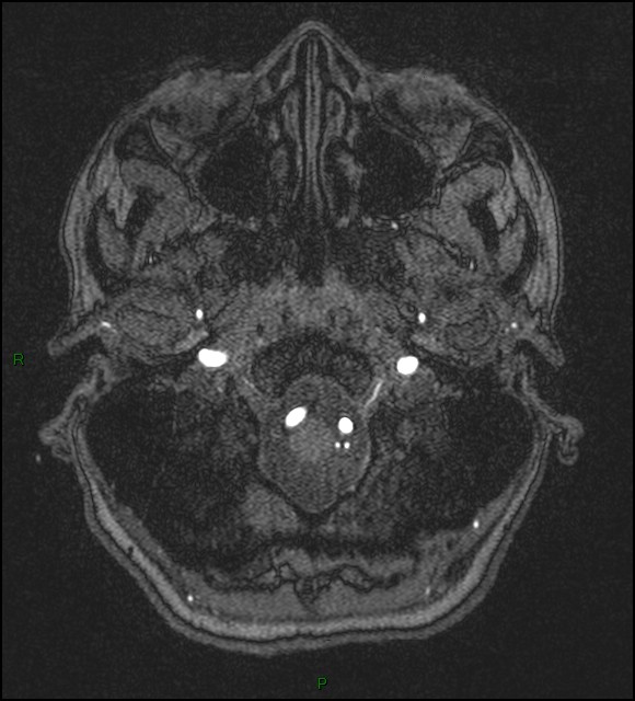 Cerebral fat embolism (Radiopaedia 35022-36525 Axial TOF 15).jpg