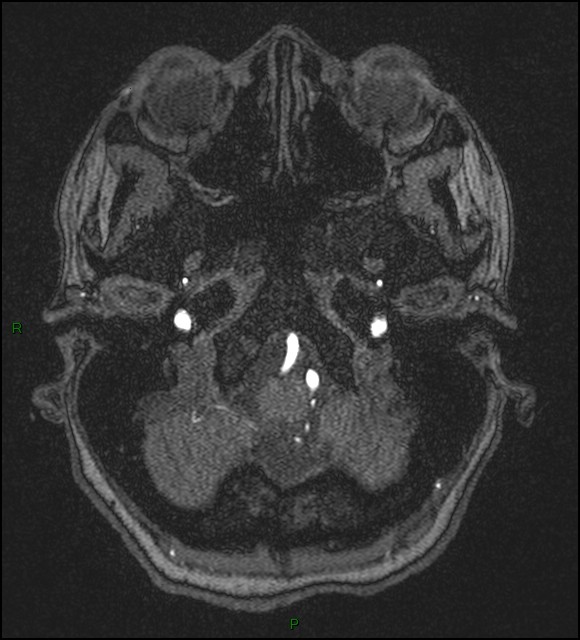 Cerebral fat embolism (Radiopaedia 35022-36525 Axial TOF 23).jpg