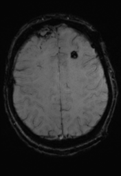 File:Cerebral hemorrhagic contusions- temporal evolution (Radiopaedia 40224-42757 D 29).png
