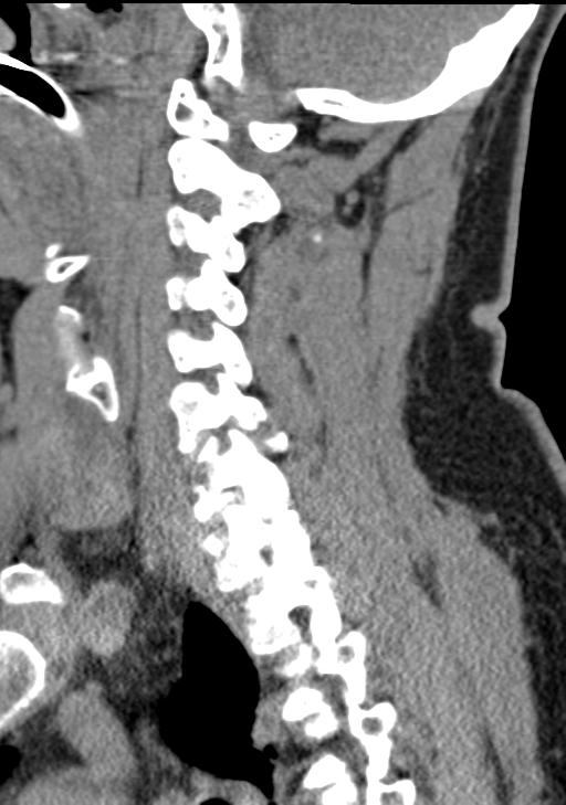 Cerebral hemorrhagic contusions and cervical spine fractures (Radiopaedia 32865-33841 G 68).jpg