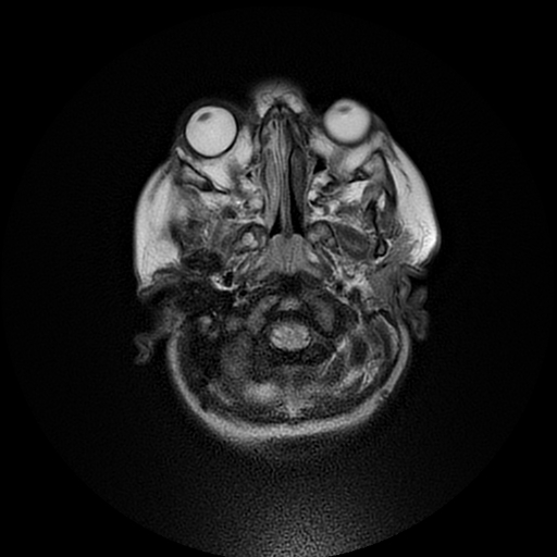 File:Cerebral manifestations of mucopolysaccharidosis type I (Radiopaedia 59171-66487 Axial T2 2).jpg