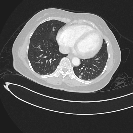 Cerebral metastases (Radiopaedia 33041-34055 Axial lung window 38).png