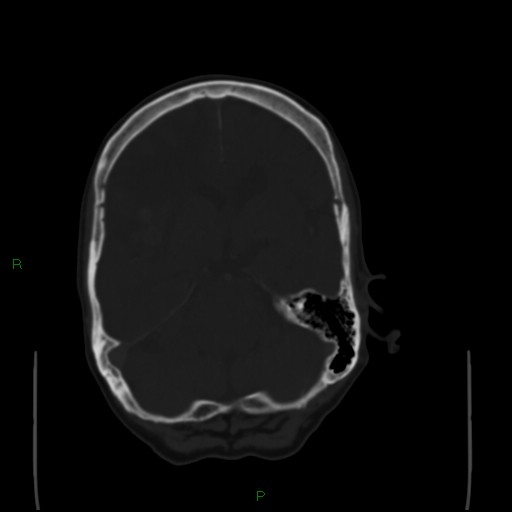 File:Cerebral metastases - breast primary (Radiopaedia 77653-89857 Axial bone window 43).jpg