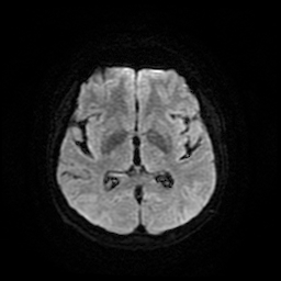 Cerebral metastases - melanoma (Radiopaedia 80972-94522 Axial DWI 16).jpg