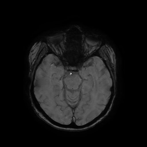 Cerebral metastases - melanoma (Radiopaedia 80972-94522 Axial SWI 39).jpg