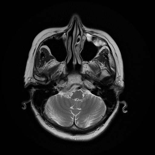 File:Cerebral metastases - melanoma (Radiopaedia 80972-94522 Axial T2 7).jpg
