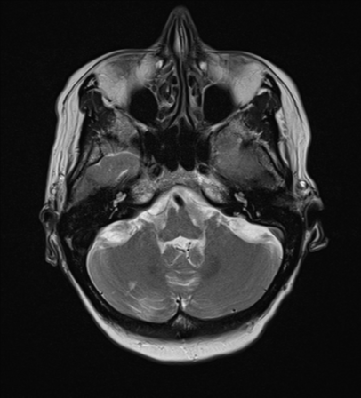 File:Cerebral metastasis (Radiopaedia 46744-51248 Axial T2 6).png