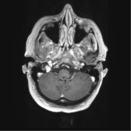 Cerebral metastasis mimicking glioblastoma (Radiopaedia 69155-78937 Axial T1 C+ 8).png