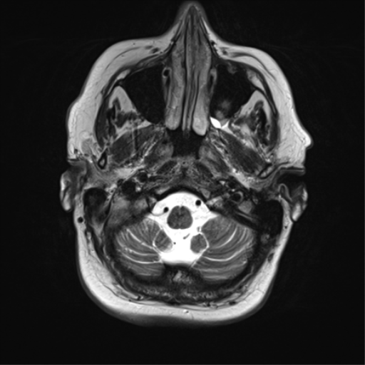 File:Cerebral metastasis mimicking glioblastoma (Radiopaedia 69155-78937 Axial T2 6).png
