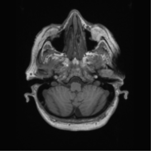 Cerebral metastasis to basal ganglia (Radiopaedia 81568-95413 Axial T1 11).png