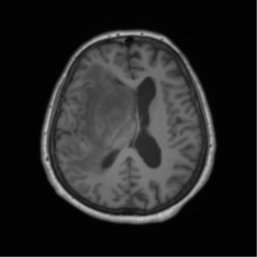 Cerebral metastasis to basal ganglia (Radiopaedia 81568-95413 Axial T1 43).png