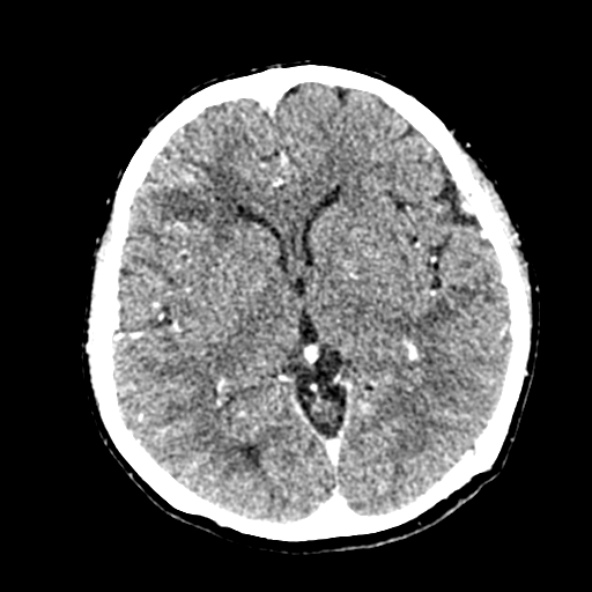 Cerebral ring enhancing lesions - cerebral metastases (Radiopaedia 44922-48818 B 143).jpg