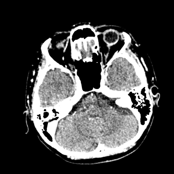 Cerebral ring enhancing lesions - cerebral metastases (Radiopaedia 44922-48818 B 81).jpg