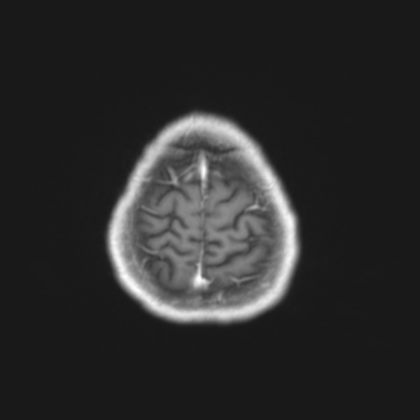 File:Cerebral toxoplasmosis (Radiopaedia 53993-61435 Axial T1 23).jpg