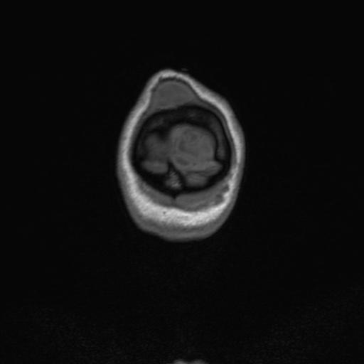 Cerebral tuberculosis with dural sinus invasion (Radiopaedia 60353-68090 Coronal T1 175).jpg