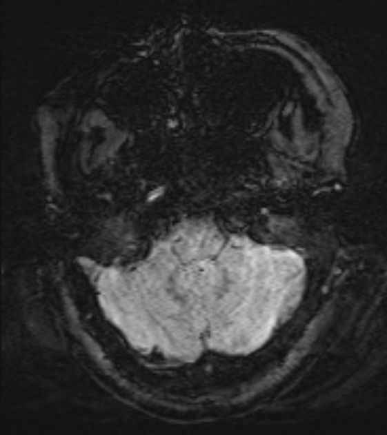 Cerebral venous infarct (Radiopaedia 53627-59685 Axial SWI 8).jpg