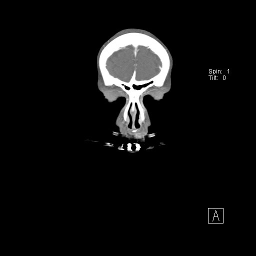 Cerebral venous infarction with hemorrhage (Radiopaedia 65343-74396 B 12).jpg