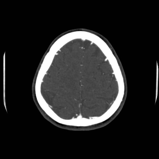 Cerebral venous sinus thrombosis (Radiopaedia 40619-43227 A 192).jpg