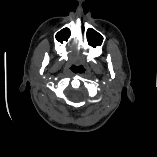 Cerebral venous sinus thrombosis (Radiopaedia 40619-43227 A 6).jpg