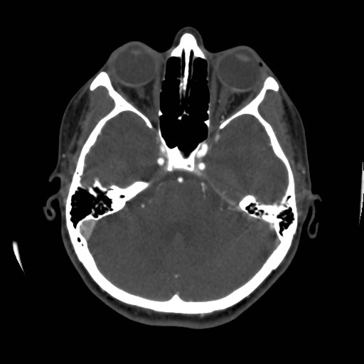 Cerebral venous sinus thrombosis (Radiopaedia 40619-43227 A 67).jpg