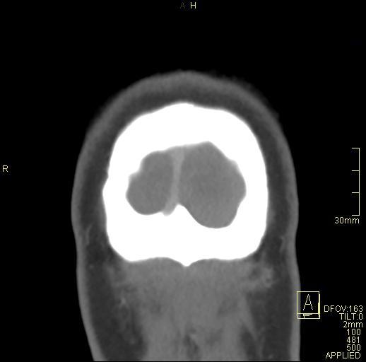 Cerebral venous sinus thrombosis (Radiopaedia 91329-108965 Coronal venogram 85).jpg