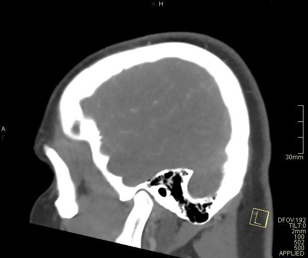 File:Cerebral venous sinus thrombosis (Radiopaedia 91329-108965 Sagittal venogram 64).jpg