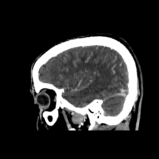 File:Cerebral venous thrombosis (CVT) (Radiopaedia 77524-89685 Sagittal CTV 7).jpg