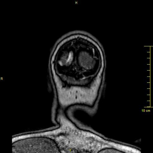 Cerebral venous thrombosis (Radiopaedia 23288-23351 MRV 176).JPG