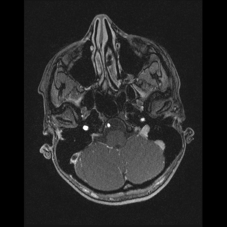 Cerebral venous thrombosis (Radiopaedia 45678-49854 Axial MRV 9).jpg