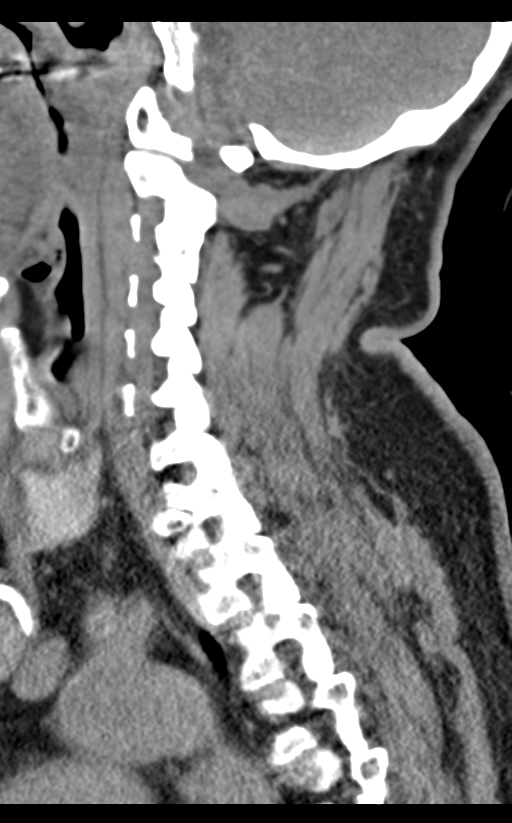 Cervical canal stenosis - OPLL and osteophytes (Radiopaedia 47329-51910 B 30).png