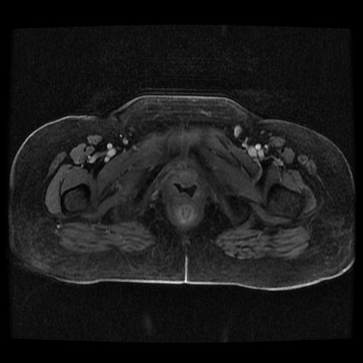 Cervical carcinoma (Radiopaedia 70924-81132 Axial T1 C+ fat sat 112).jpg