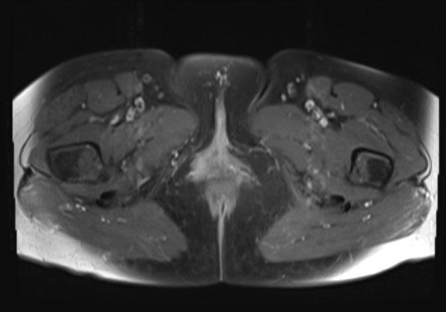 File:Cervical carcinoma (Radiopaedia 88312-104943 Axial T1 C+ fat sat 22).jpg