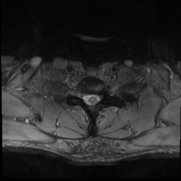 File:Cervical disc extrusion (Radiopaedia 53950-60077 Axial T2 30).jpg