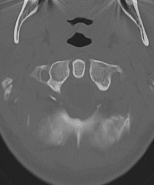 Cervical intercalary bone (Radiopaedia 35211-36748 Axial bone window 14).png