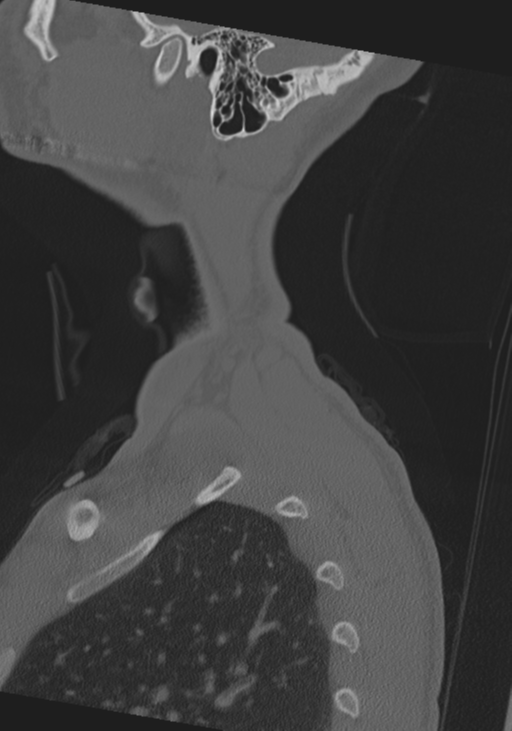 Cervical intercalary bone (Radiopaedia 35211-36748 Sagittal bone window 80).png
