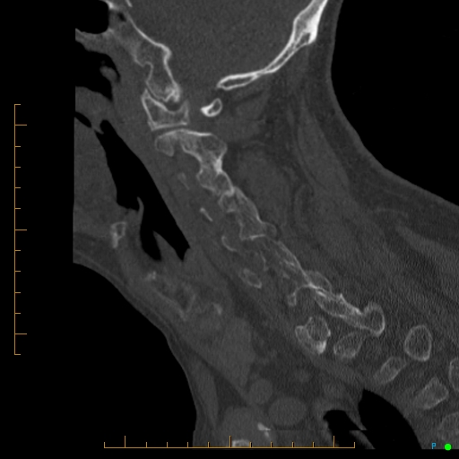 Cervical spine fracture - ankylosing spondylitis (Radiopaedia 76835-88706 Sagittal bone window 75).jpg