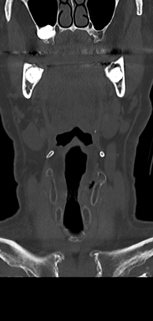 Cervical spine fracture - chalk stick (Radiopaedia 39116-41323 Coronal bone window 1).png