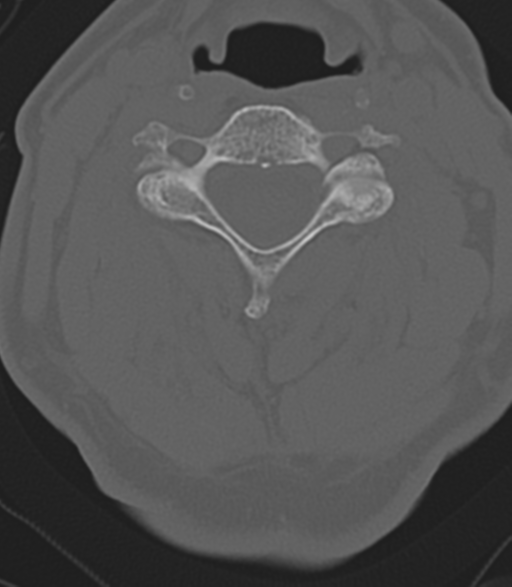 File:Cervical spine fractures with vertebral artery dissection (Radiopaedia 53296-59268 Axial bone window 28).png