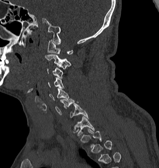 Cervical spine trauma with tear drop fracture and perched facet joint (Radiopaedia 53989-60127 Sagittal bone window 119).jpg