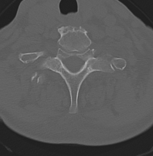 File:Cervical spondylolysis (Radiopaedia 49616-54811 Axial bone window 44).png