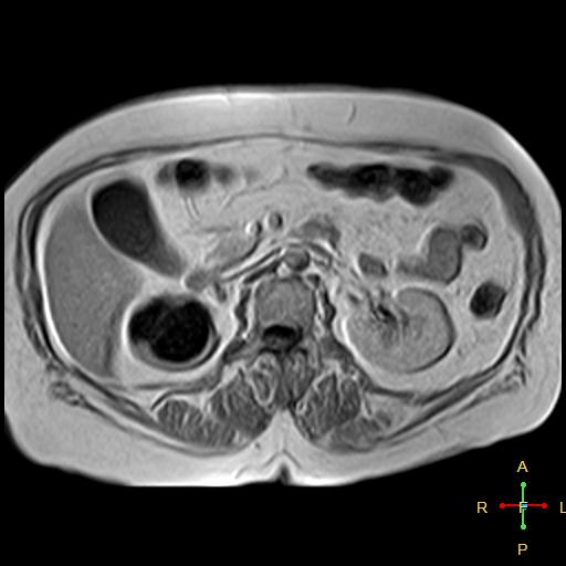 File:Cervical stump squamous cell carcinoma (Radiopaedia 48049-52858 H 3).jpg