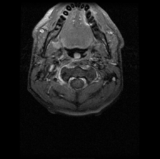 File:Cervical vertebrae metastasis (Radiopaedia 78814-91667 Axial T1 C+ fat sat 8).png
