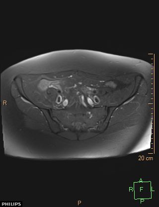 File:Cesarian scar endometriosis (Radiopaedia 68495-78066 Axial T1 C+ fat sat 4).jpg