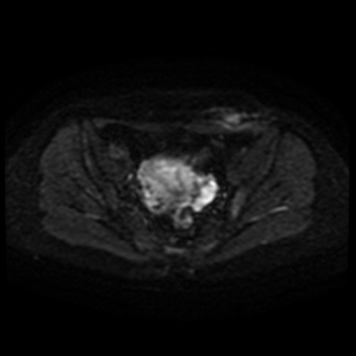 File:Cesarian section scar endometriosis (Radiopaedia 66520-75799 Axial DWI 35).jpg