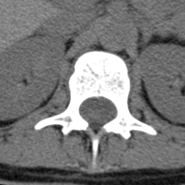 File:Chance fracture (Radiopaedia 36521-38081 Axial non-contrast 67).jpg
