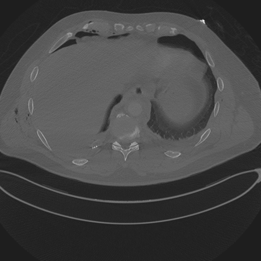 Chest multitrauma - aortic injury (Radiopaedia 34708-36147 Axial bone window 240).png