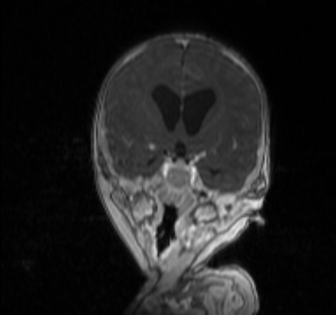 Chiari III malformation with occipital encephalocele (Radiopaedia 79446-92559 Coronal T1 C+ mpr 10).jpg