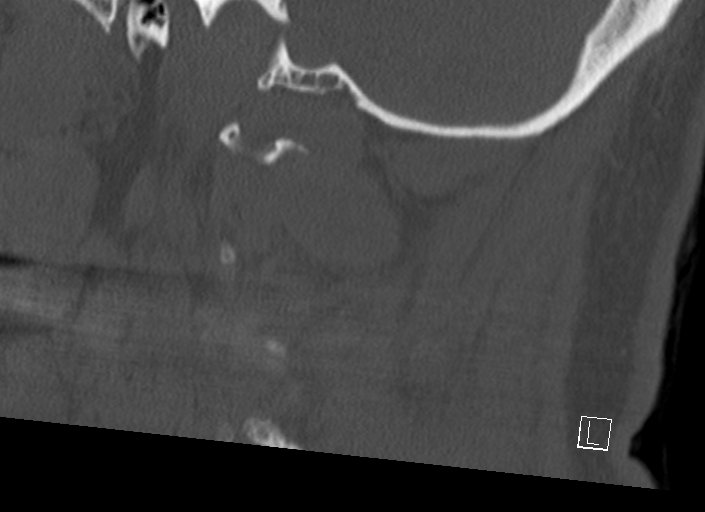 Chiari I malformation with a symptomatic syrinx of the posterolateral medulla oblongata (Radiopaedia 42573-45707 A 15).jpg